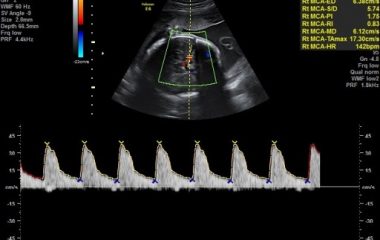 (SUA) עורק טבורי בודד – Single Umbilical Artery